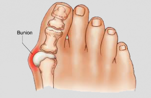 Bunions - their causes, symptoms, treatment and recovery