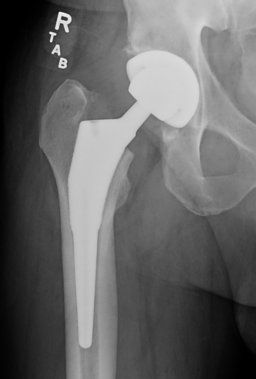 What Is An Anterior Hip Dislocation