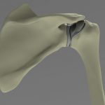 shoulder joint replacement implant