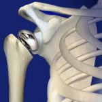 Total shoulder joint replacement surgery