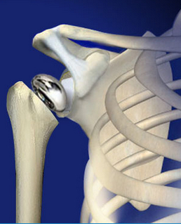 Total shoulder joint replacement | Seaside Surgery Center