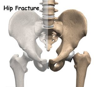 hip fractures
