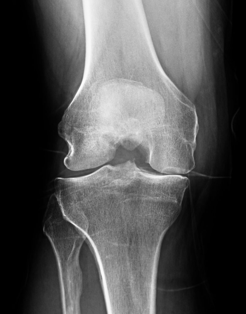 Outpatient Total Knee Replacement - Seaside Surgery Center