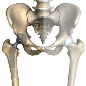 What Happens During Total Hip Replacement? - Magnolia Regional Health Center