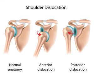 dislocated shoulder positions